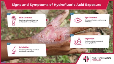 Hydrofluoric Acid Burn
