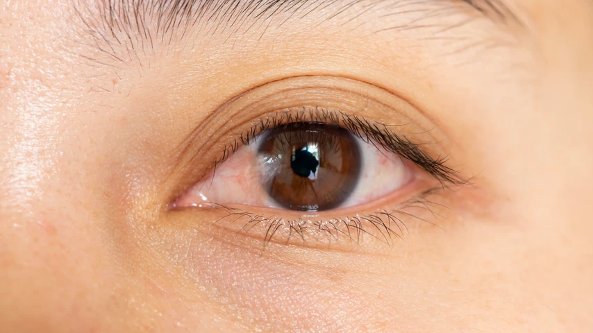pterygium photo